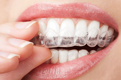 Clear tray braces
